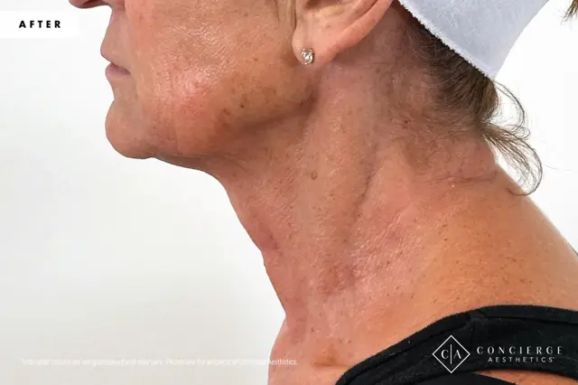 Laser Skin Resurfacing after at Concierge Aesthetics® - Botox, Dysport, CoolPeel, Juvederm, Laser, Morpheus8, Restylane, Xeomin in Irvine, CA