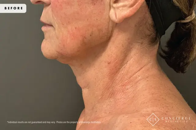 Laser Skin Resurfacing before at Concierge Aesthetics® - Botox, Dysport, CoolPeel, Juvederm, Laser, Morpheus8, Restylane, Xeomin in Irvine, CA