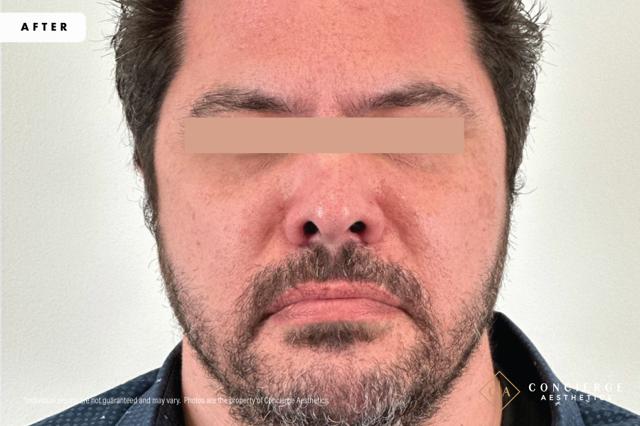 Botox after at Concierge Aesthetics® - Botox, Dysport, CoolPeel, Juvederm, Laser, Morpheus8, Restylane, Xeomin in Irvine, CA