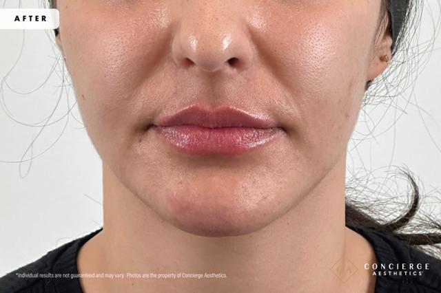 Lip Filler after at Concierge Aesthetics® - Botox, Dysport, CoolPeel, Juvederm, Laser, Morpheus8, Restylane, Xeomin in Irvine, CA