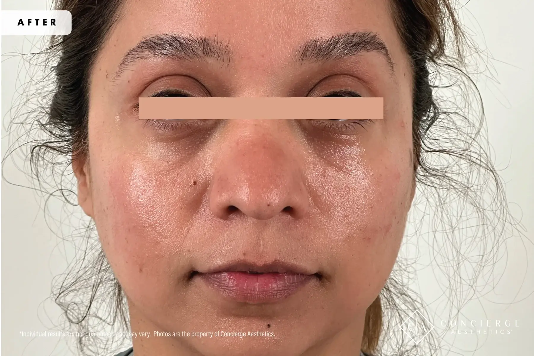 Concierge Aesthetics® - Botox, Dysport, CoolPeel, Juvederm, Laser, Morpheus8, Restylane, Xeomin undereye filler after — Irvine, CA