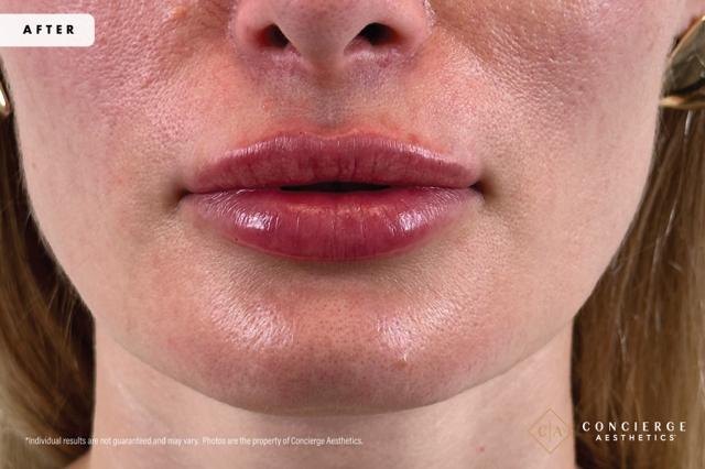 Lip Filler after at Concierge Aesthetics® - Botox, Dysport, CoolPeel, Juvederm, Laser, Morpheus8, Restylane, Xeomin in Irvine, CA