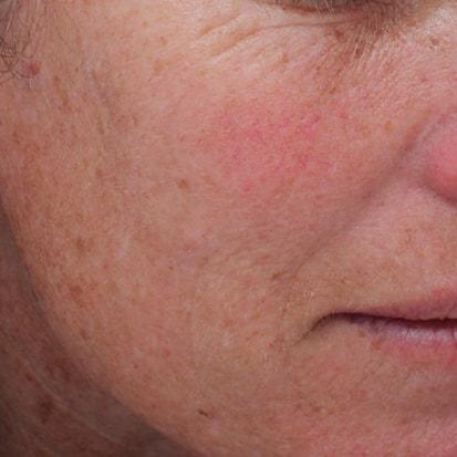 Laser Skin Resurfacing before at Spa Trouvé in Pleasant Grove, UT