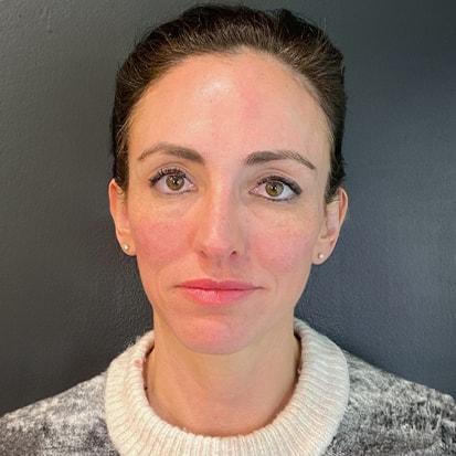 Spa Trouvé cheek filler after — Pleasant Grove, UT