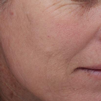 Laser Skin Resurfacing after at Spa Trouvé in Pleasant Grove, UT