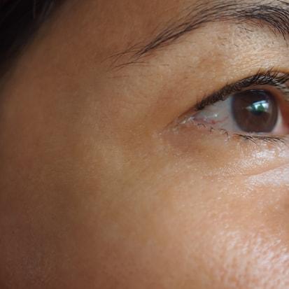 Spa Trouvé under-eye filler after — Pleasant Grove, UT