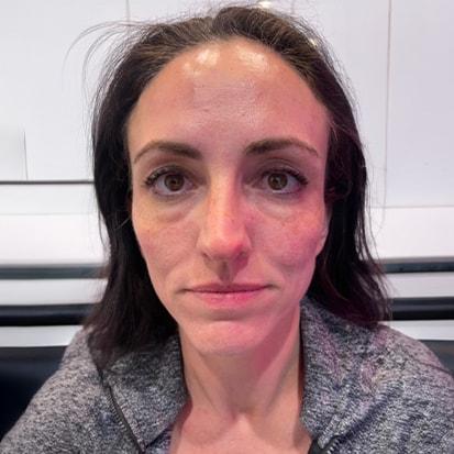 Dermal Fillers before at Spa Trouvé in Pleasant Grove, UT
