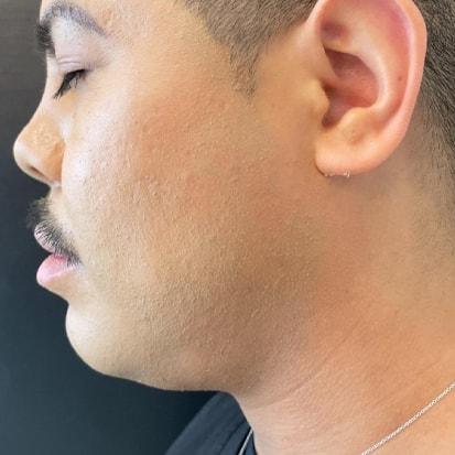 Jawline Filler before at Spa Trouvé in Pleasant Grove, UT