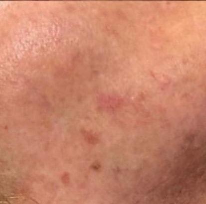 Spa Trouvé photofacial after — Pleasant Grove, UT