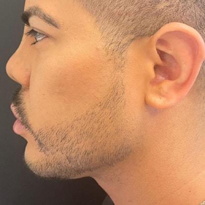 Jawline Filler after at Spa Trouvé in Pleasant Grove, UT