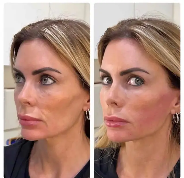 Dermal Fillers result at RO Aesthetics in Salt Lake City, UT