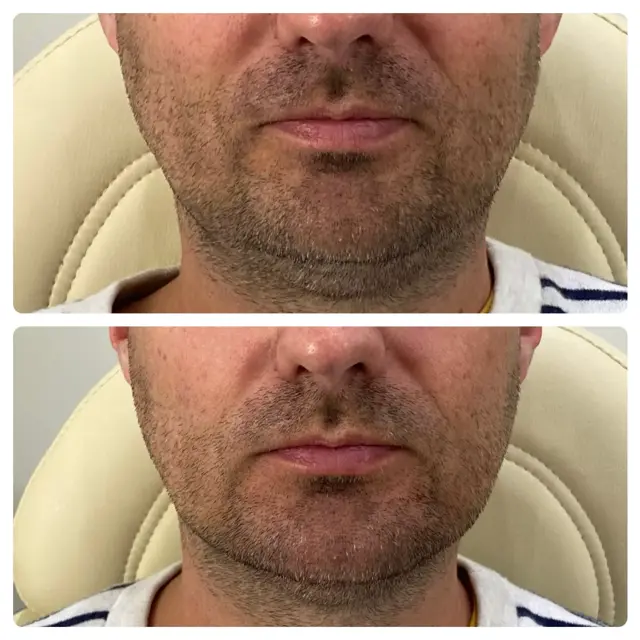 Jawline Filler result at RO Aesthetics in Salt Lake City, UT