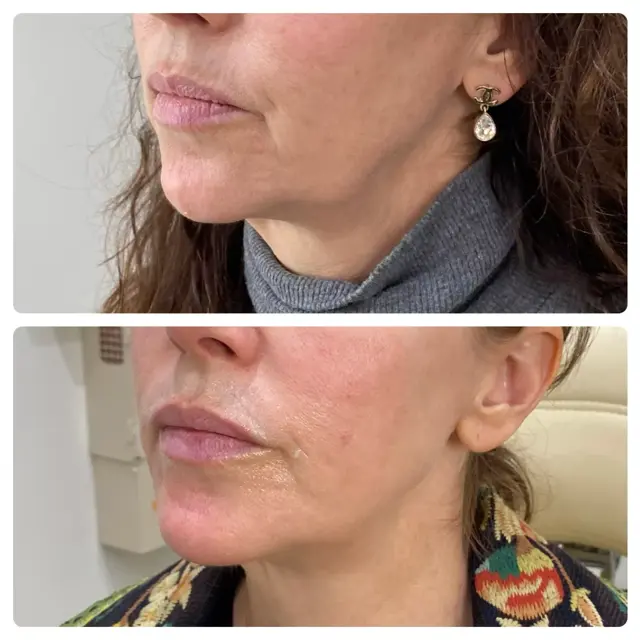 Kybella result at RO Aesthetics in Salt Lake City, UT