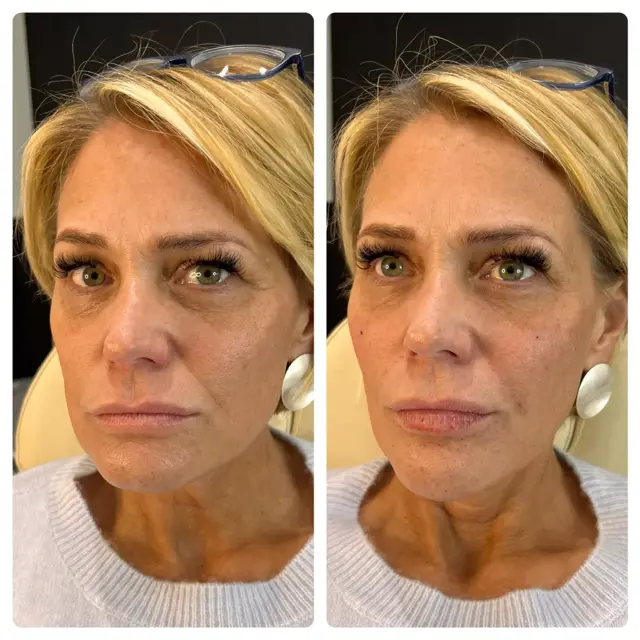 Dermal Fillers result at RO Aesthetics in Salt Lake City, UT