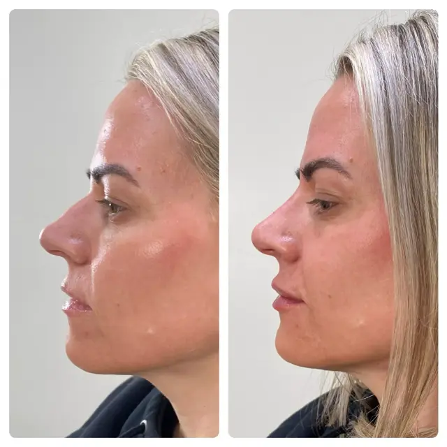 Rhinoplasty result at RO Aesthetics in Salt Lake City, UT