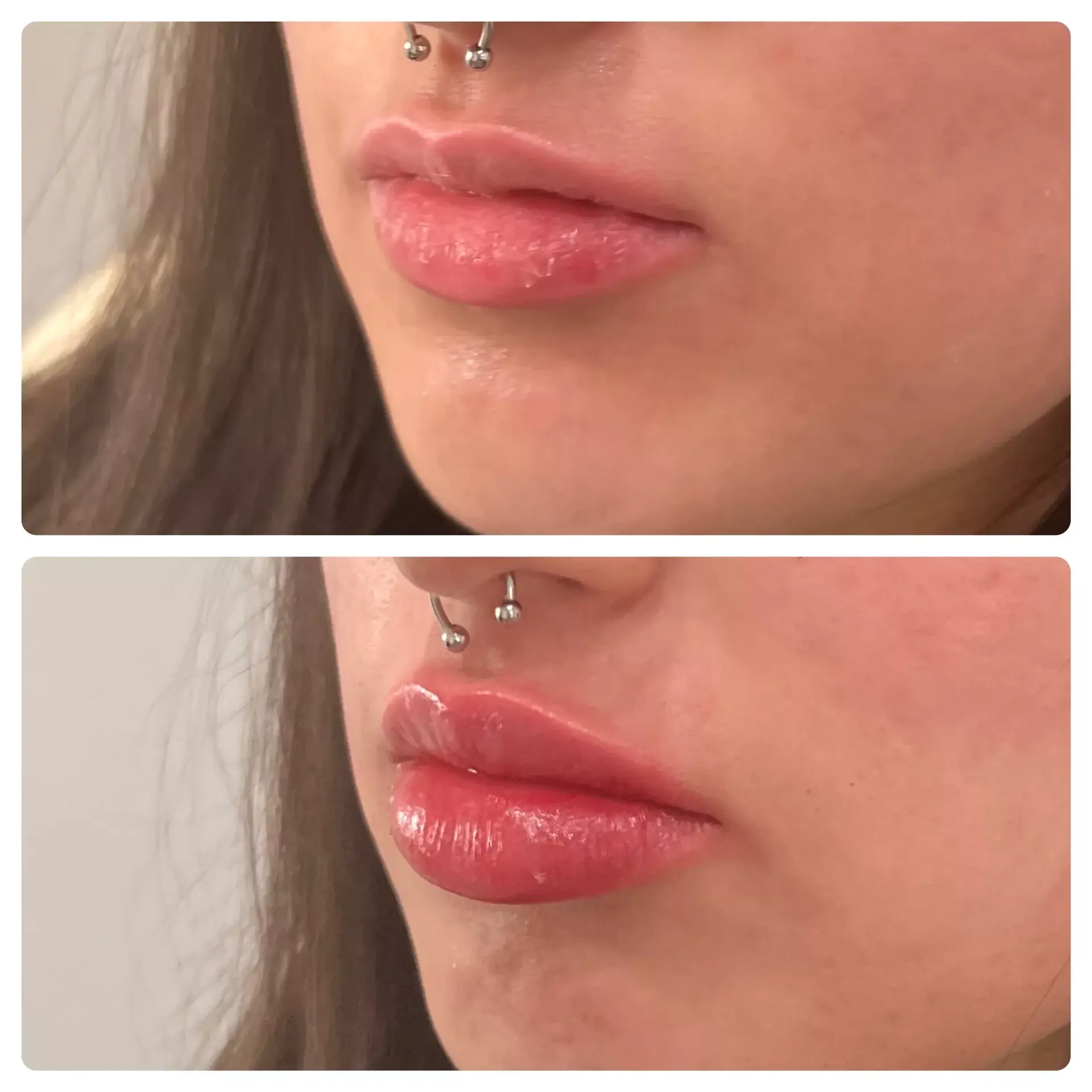 RO Aesthetics lip filler result — Salt Lake City, UT