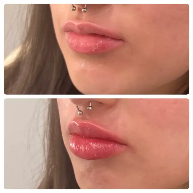 Lip Filler result at RO Aesthetics in Salt Lake City, UT