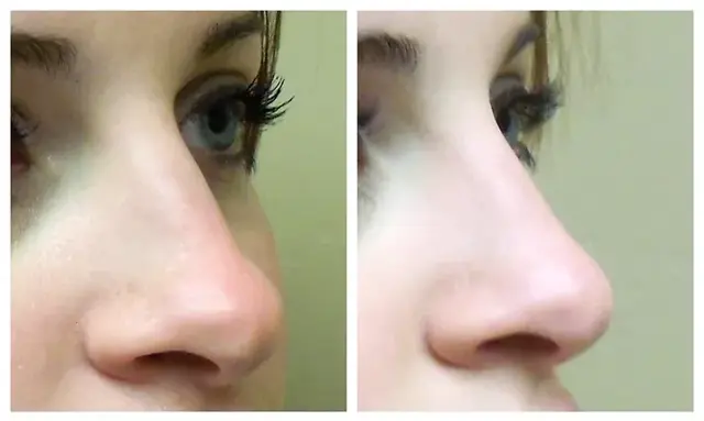 Liquid Rhinoplasty result at RO Aesthetics in Salt Lake City, UT