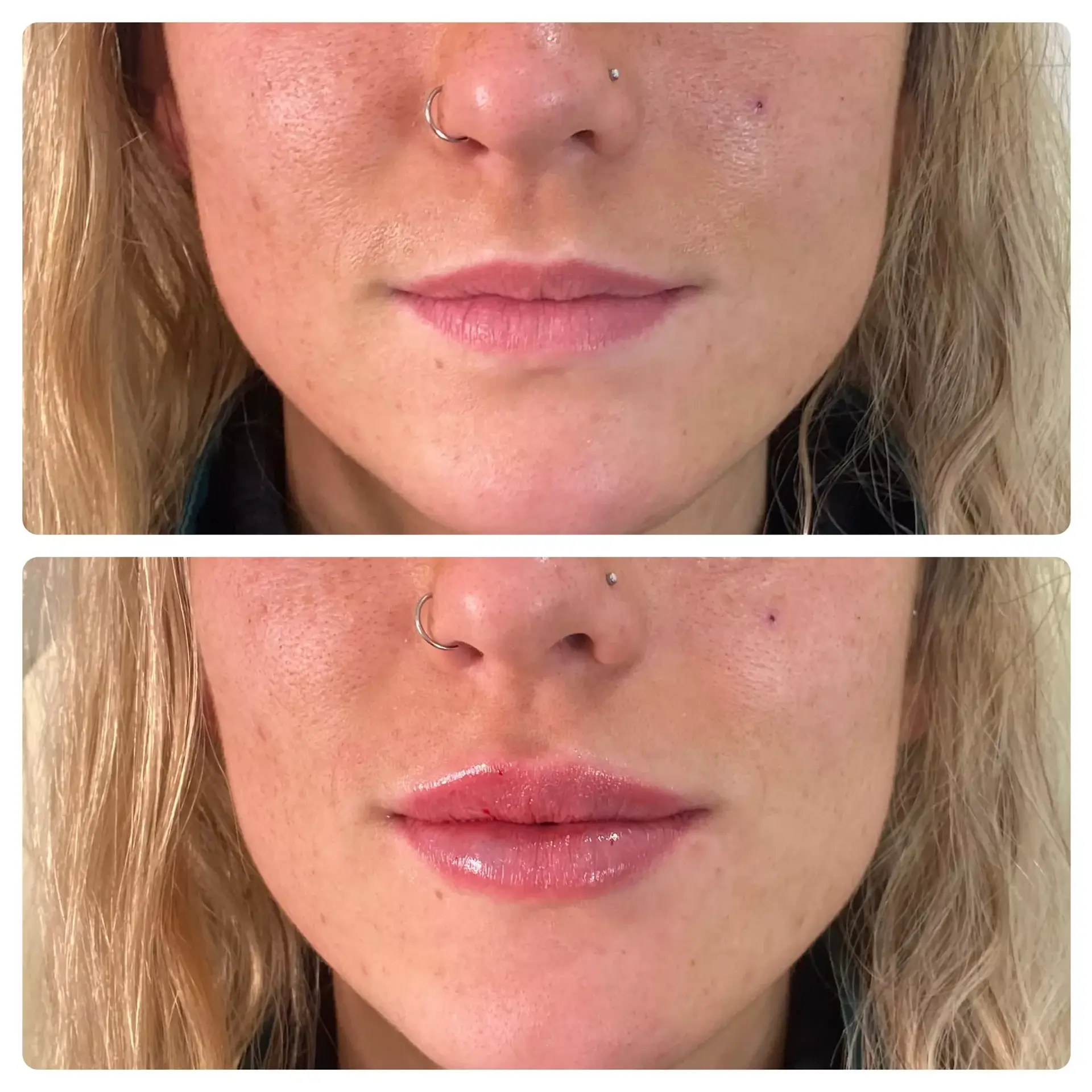 RO Aesthetics lip filler result — Salt Lake City, UT