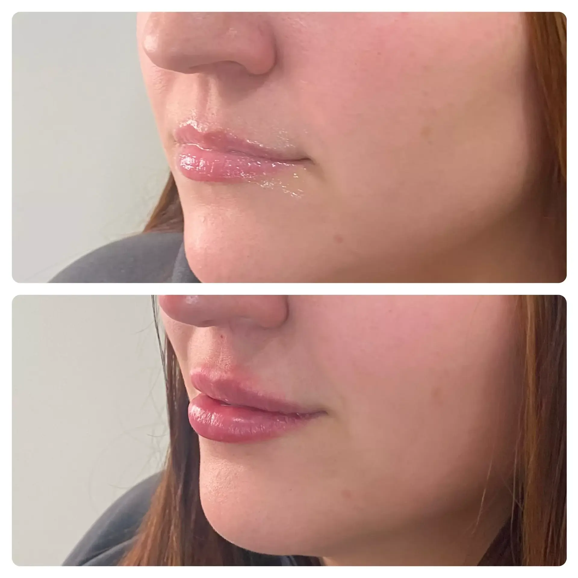 RO Aesthetics lip filler result — Salt Lake City, UT
