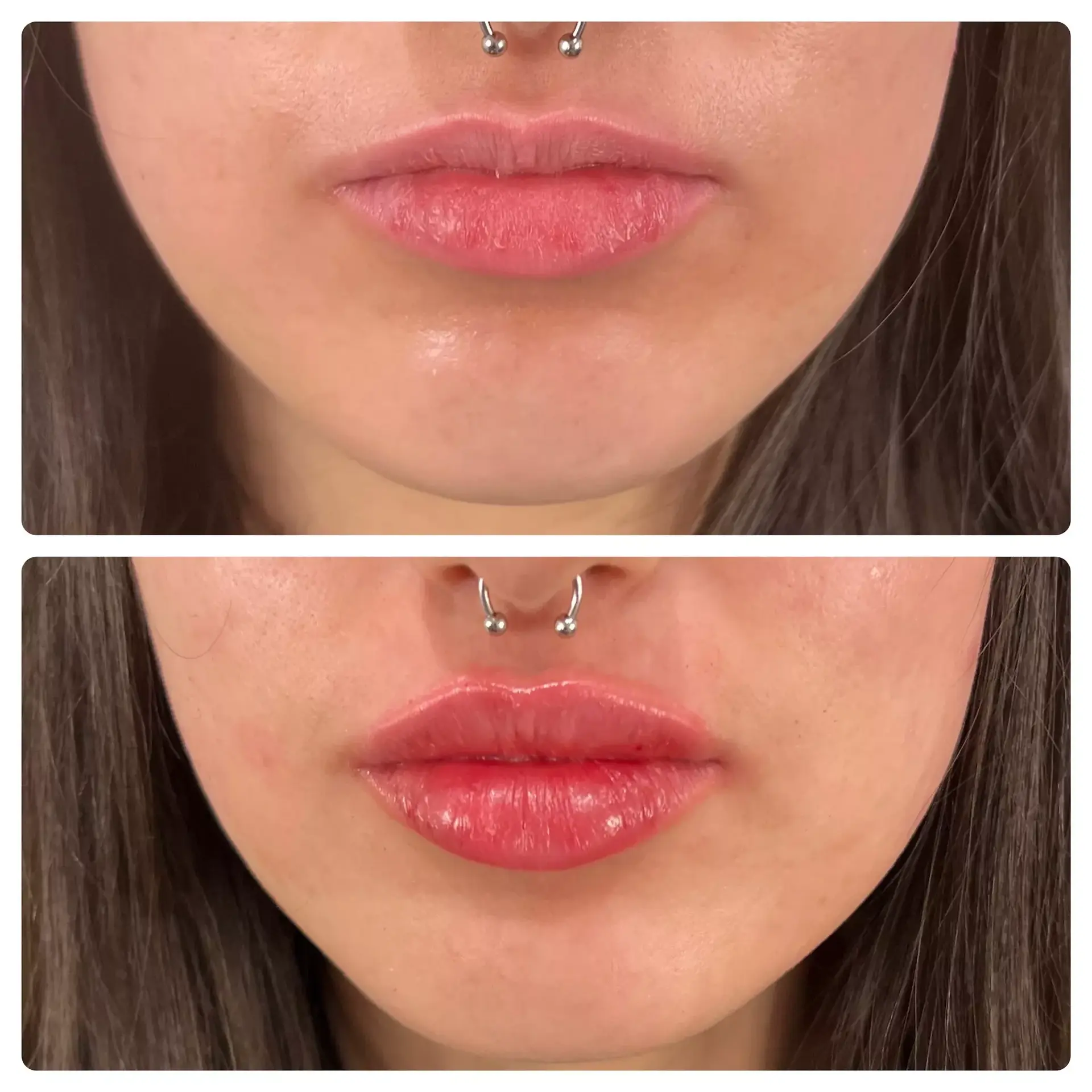 RO Aesthetics lip filler result — Salt Lake City, UT