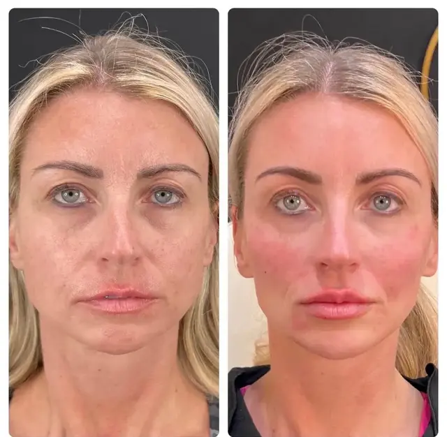 Juvederm result at RO Aesthetics in Salt Lake City, UT