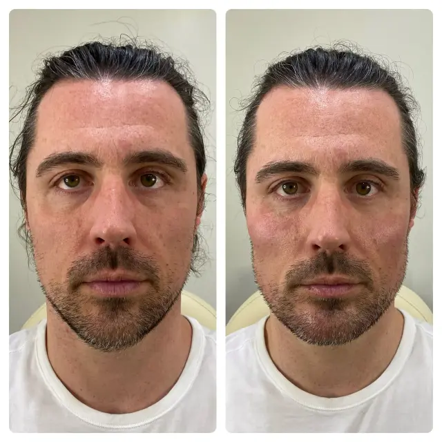 Jawline Filler result at RO Aesthetics in Salt Lake City, UT