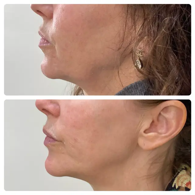 Kybella result at RO Aesthetics in Salt Lake City, UT