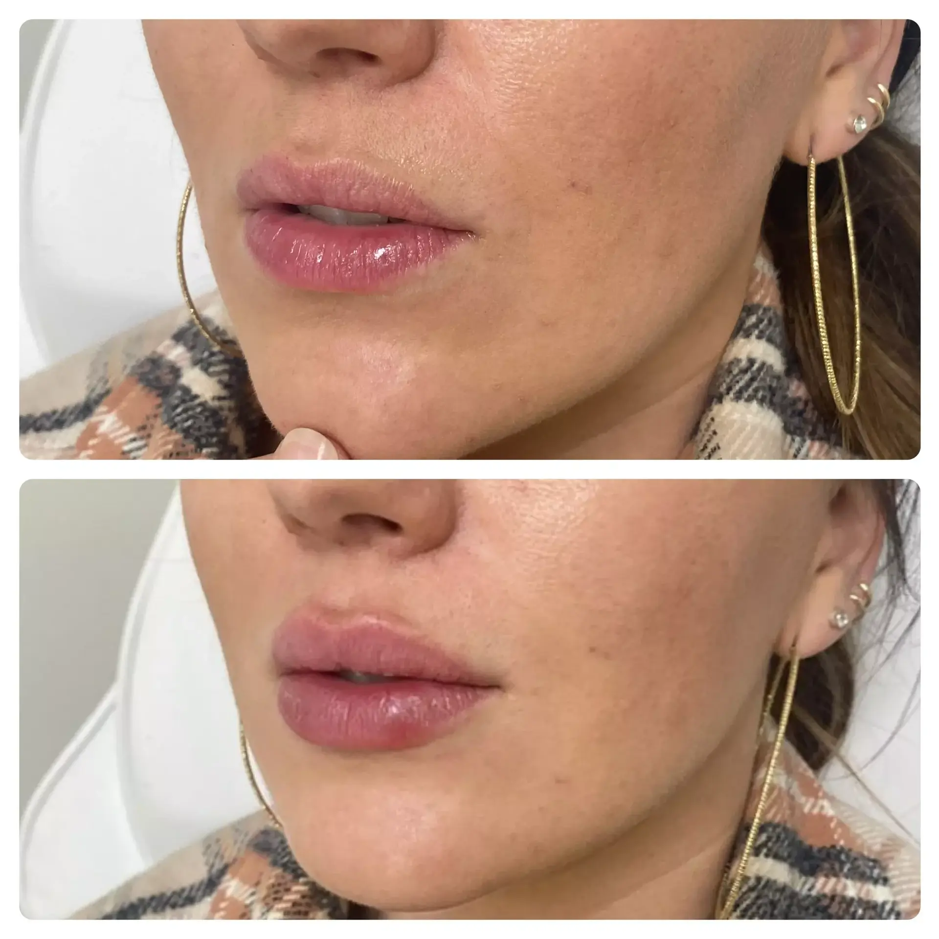 RO Aesthetics lip filler result — Salt Lake City, UT