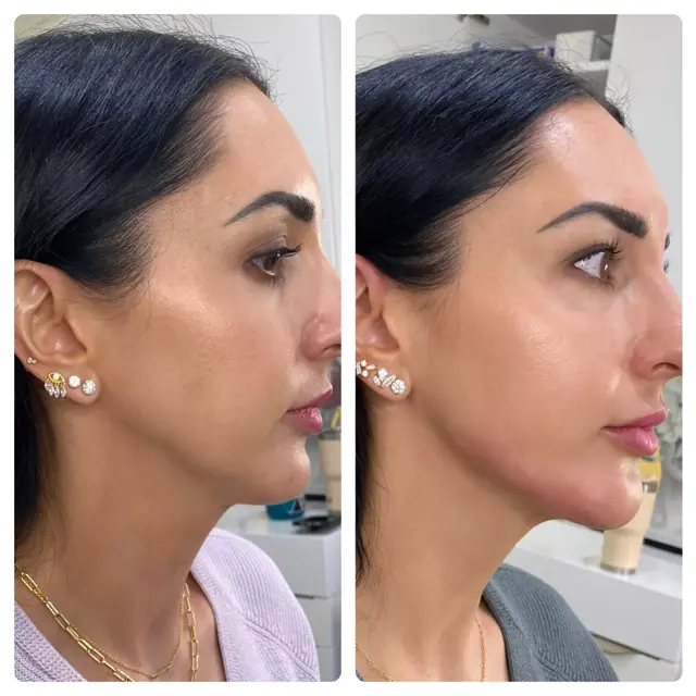 Jawline Filler result at RO Aesthetics in Salt Lake City, UT