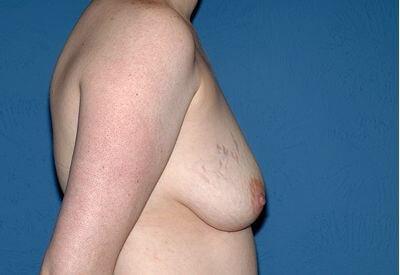 Breast Lift before at USA Plastic Surgery in Dallas, TX