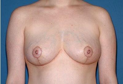 Breast Lift after at USA Plastic Surgery in Dallas, TX