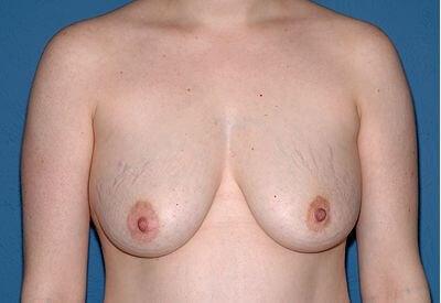 Breast Lift before at USA Plastic Surgery in Dallas, TX