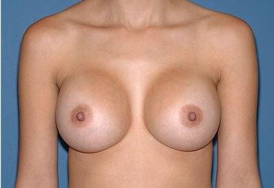 USA Plastic Surgery breast augmentation after — Dallas, TX