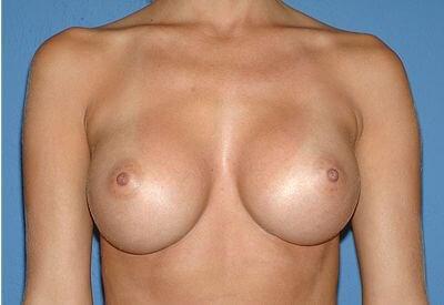 USA Plastic Surgery breast augmentation after — Dallas, TX
