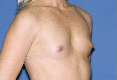 Fat Transfer Breast Augmentation before at USA Plastic Surgery in Dallas, TX