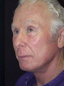 Altos Oaks Plastic Surgery facelift after — Los Altos, CA
