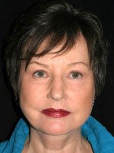 Altos Oaks Plastic Surgery facelift after — Los Altos, CA