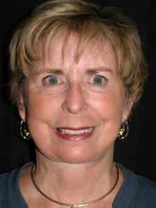 Altos Oaks Plastic Surgery facelift after — Los Altos, CA