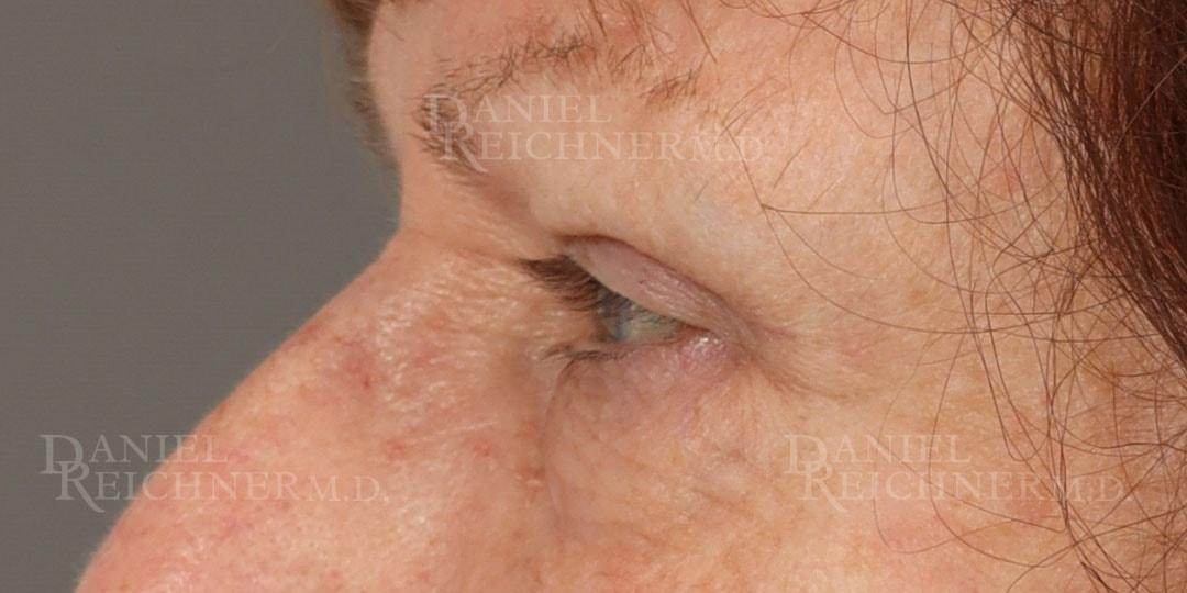 Daniel Reichner, MD, FACS eyelid lift after — Orange, CA