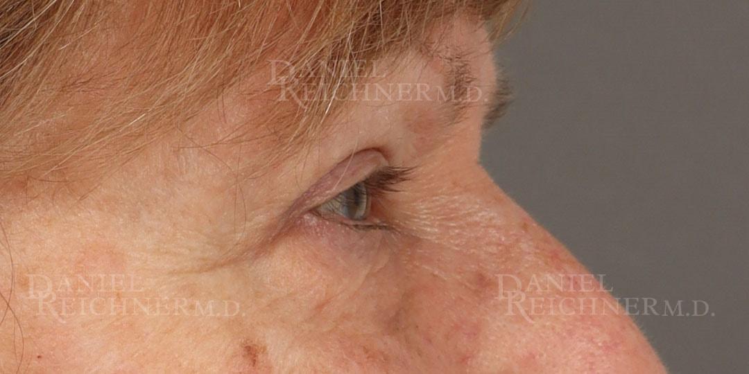 Daniel Reichner, MD, FACS eyelid lift after — Orange, CA