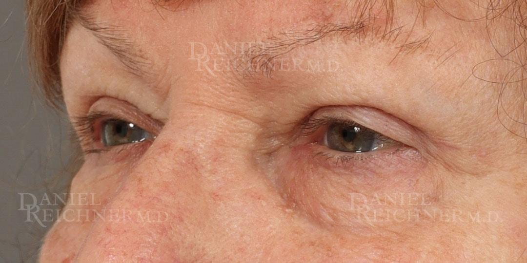 Daniel Reichner, MD, FACS eyelid lift after — Orange, CA
