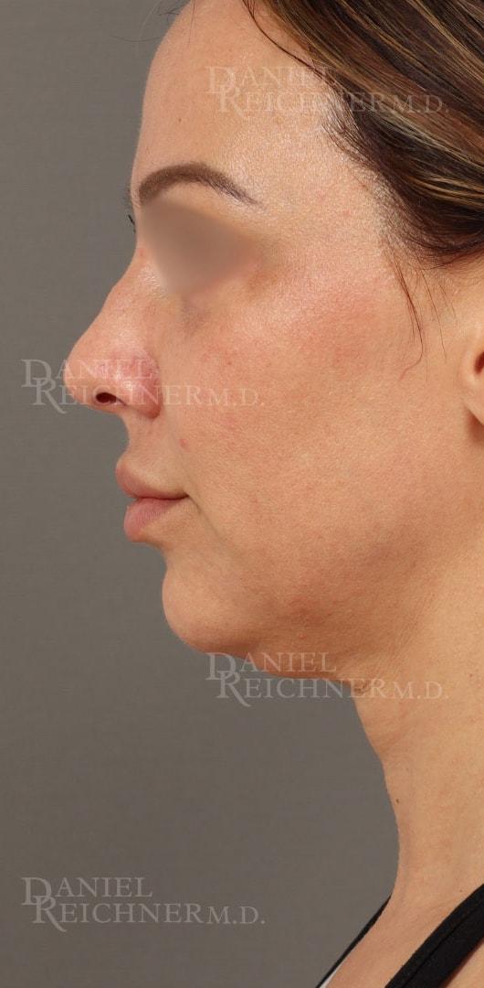 Neck Lift before at Daniel Reichner, MD, FACS in Orange, CA