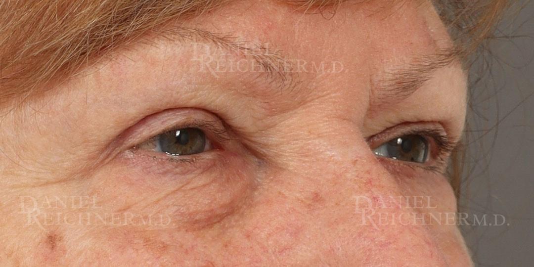 Daniel Reichner, MD, FACS eyelid lift after — Orange, CA