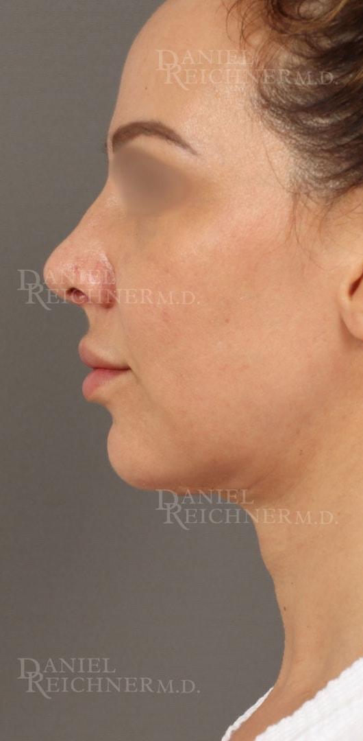 Neck Lift after at Daniel Reichner, MD, FACS in Orange, CA