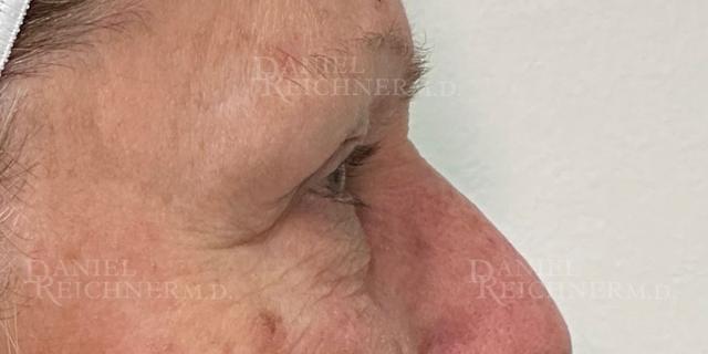 Blepharoplasty before at Daniel Reichner, MD, FACS in Orange, CA