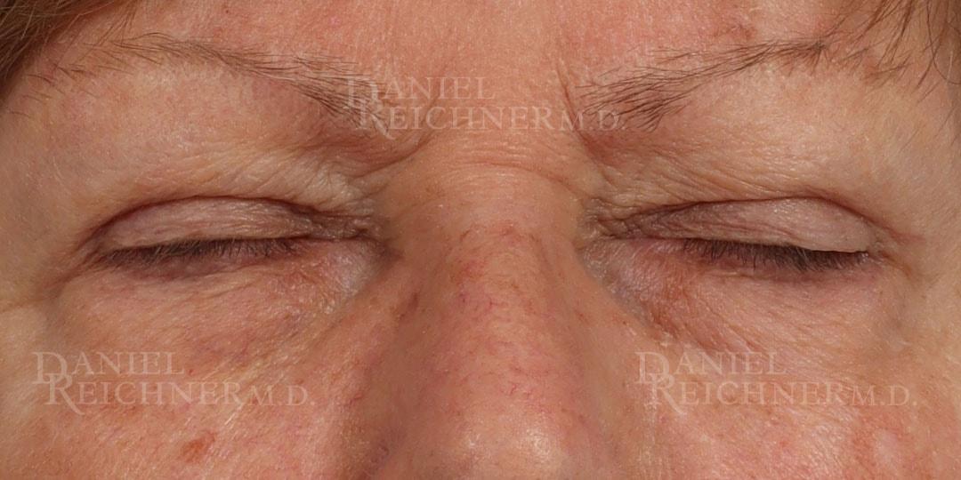 Daniel Reichner, MD, FACS eyelid lift after — Orange, CA