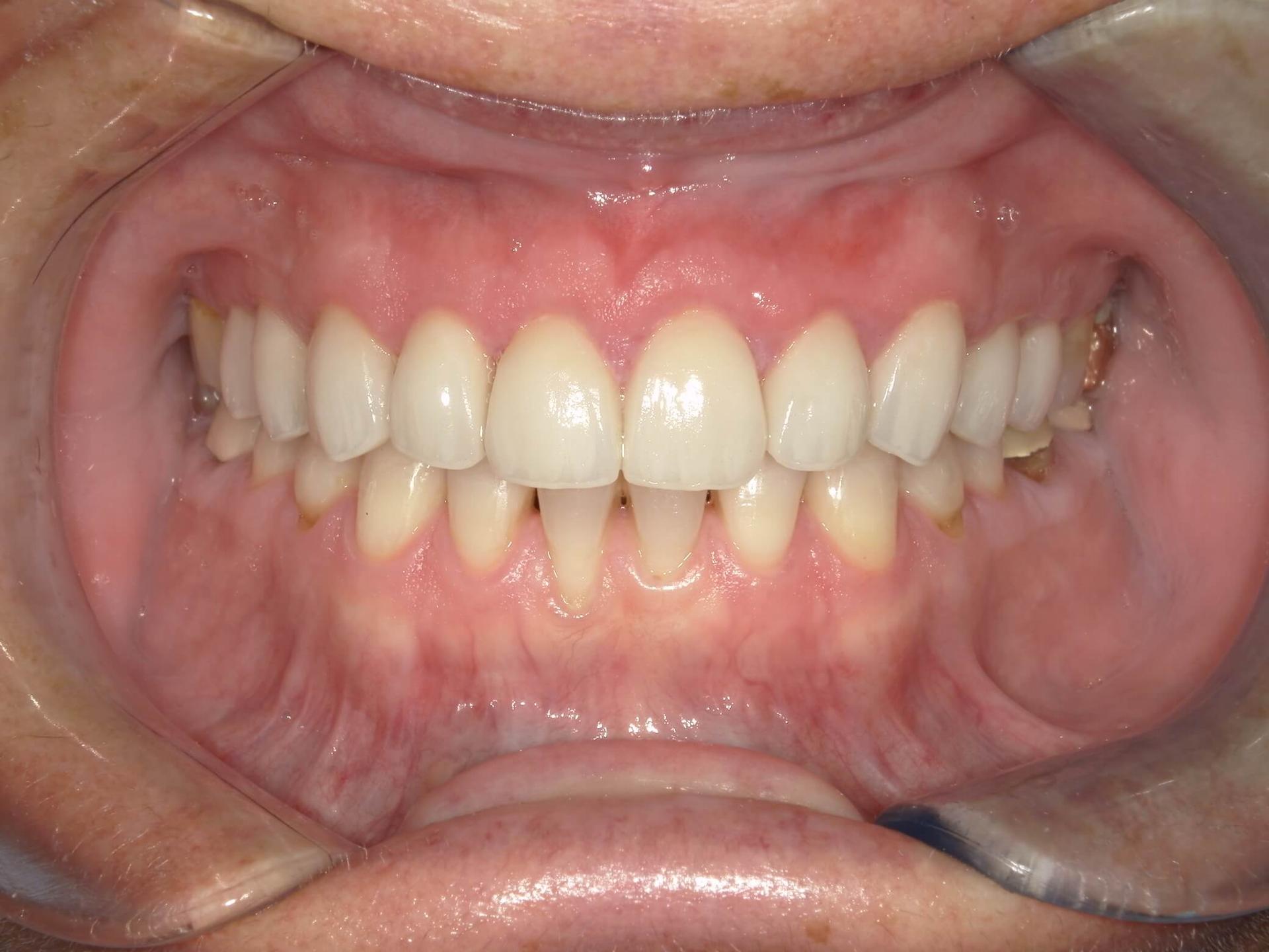 Fossil Creek Dental smile makeover after — Fort Worth, TX