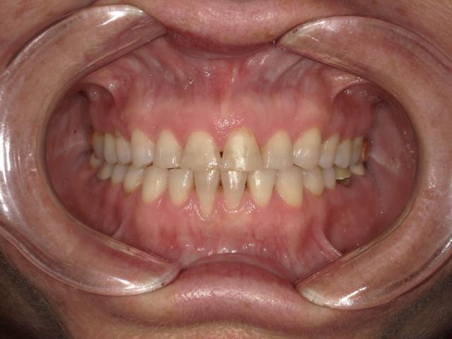 Smile Makeover before at Fossil Creek Dental in Fort Worth, TX