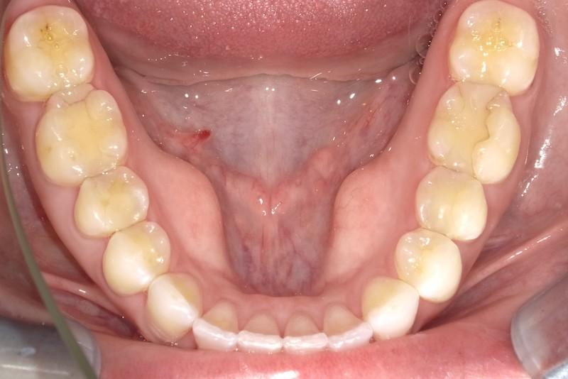 Fossil Creek Dental smile makeover after — Fort Worth, TX